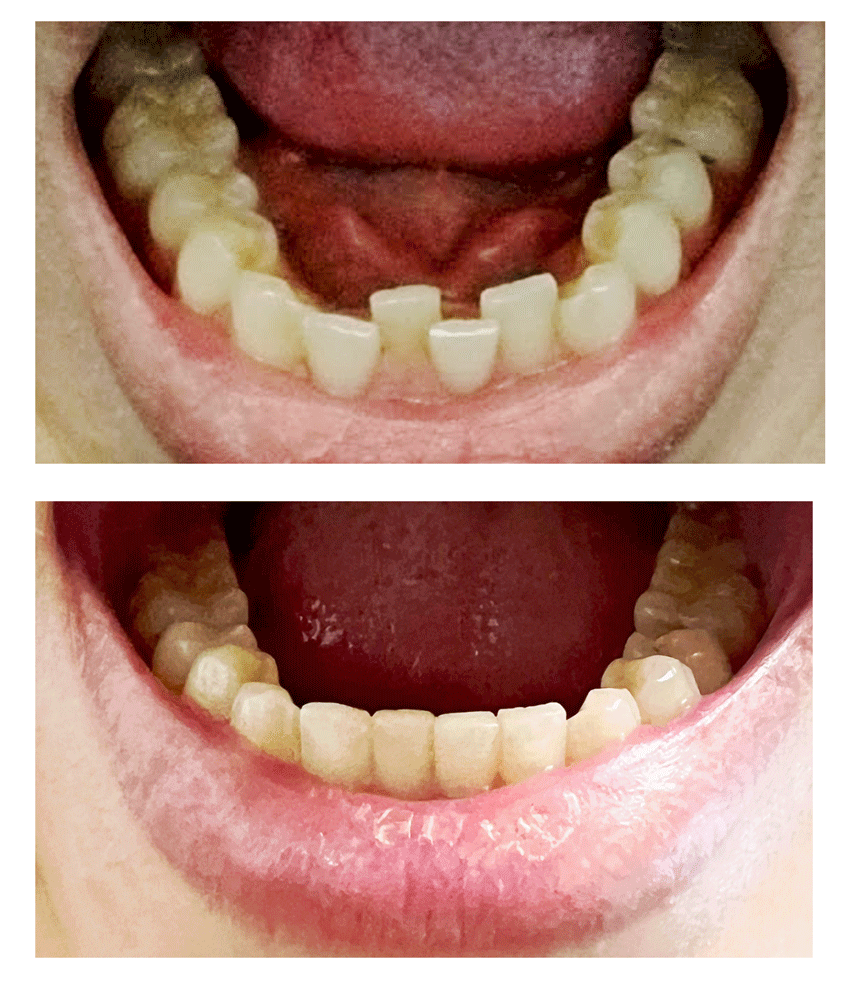 浅草KT歯科院長の歯並び矯正治療前後
