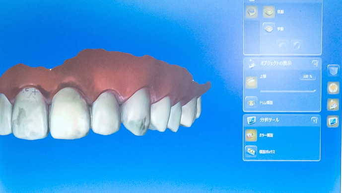 治療計画の3Dシミュレーション画面